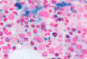 Blood clot from a bone marrow aspirate showing ring sideroblasts