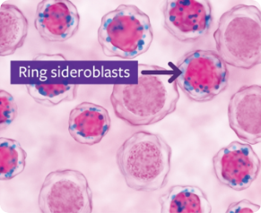 Ring sideroblast in bone marrow